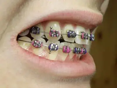 braces treatment