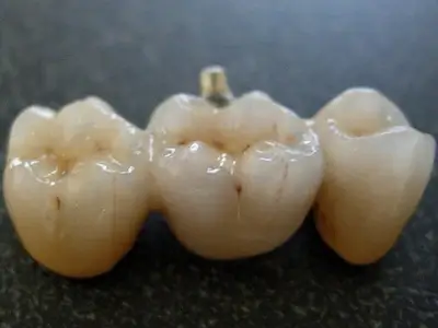 Dental Bridge