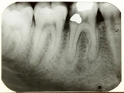 Dental X Ray