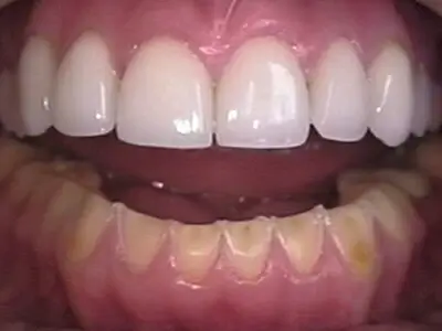 Full Mouth Rehabilitation