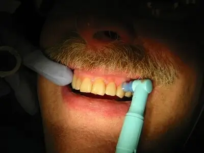 dental cleaning